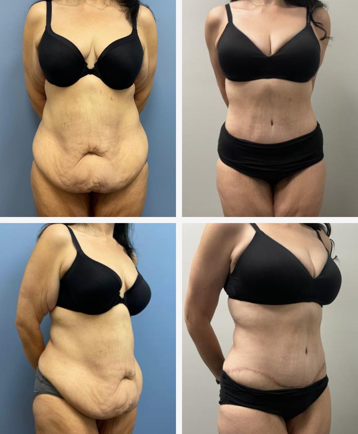 Panniculectomy Surgery Performed by Dr. Bonett