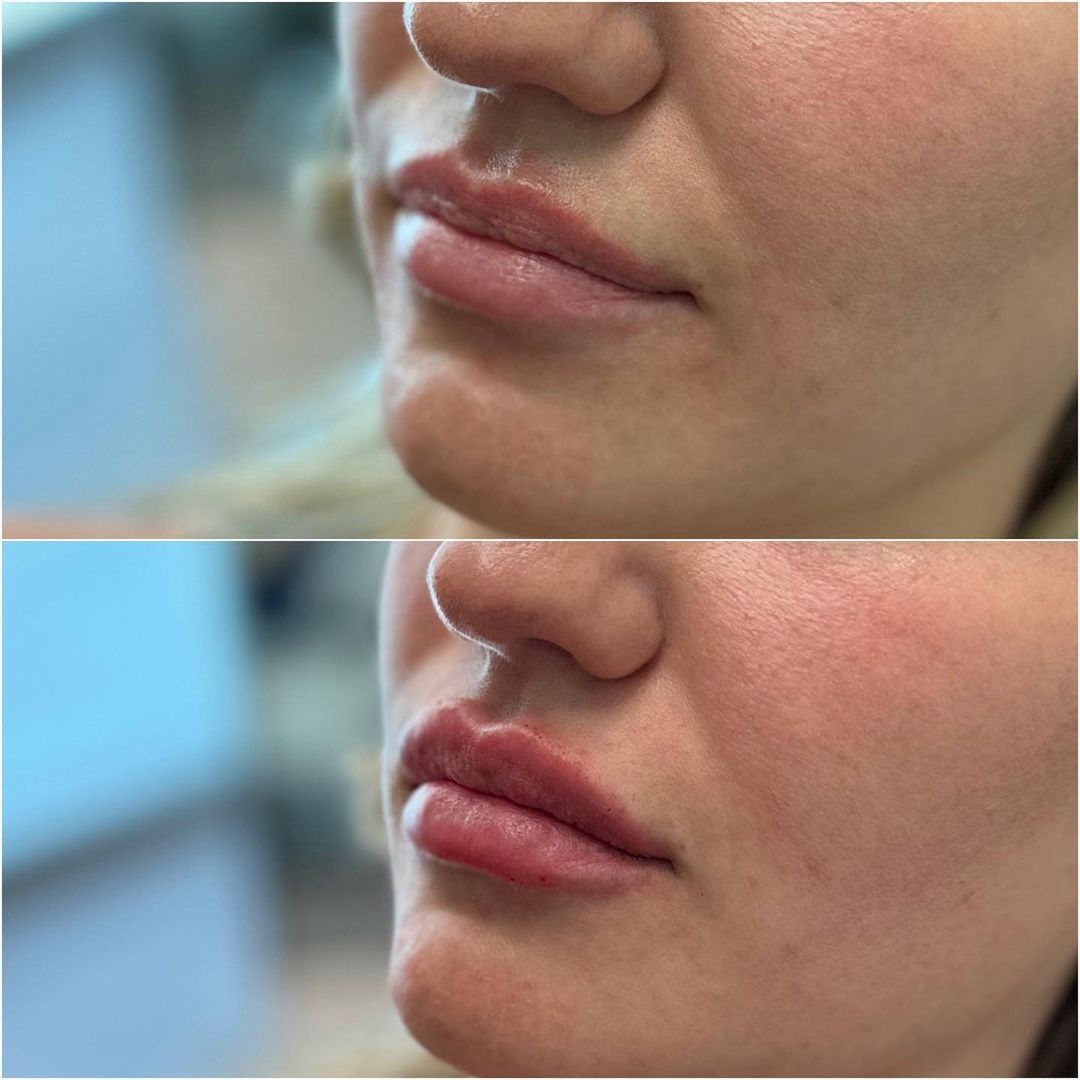 Lip Augmentation by Dr. Baccaro