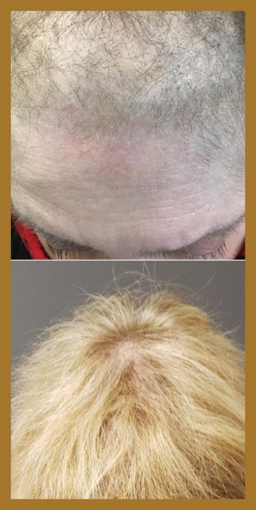 image of before and after hair loss restoration