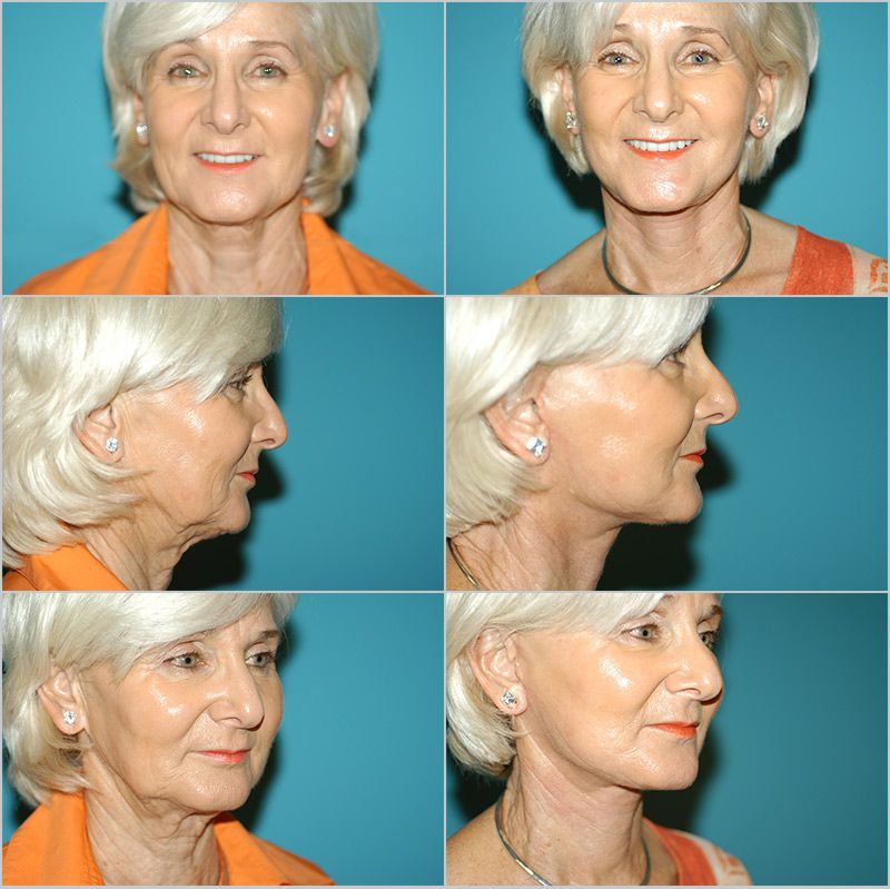 Neck Lift 03