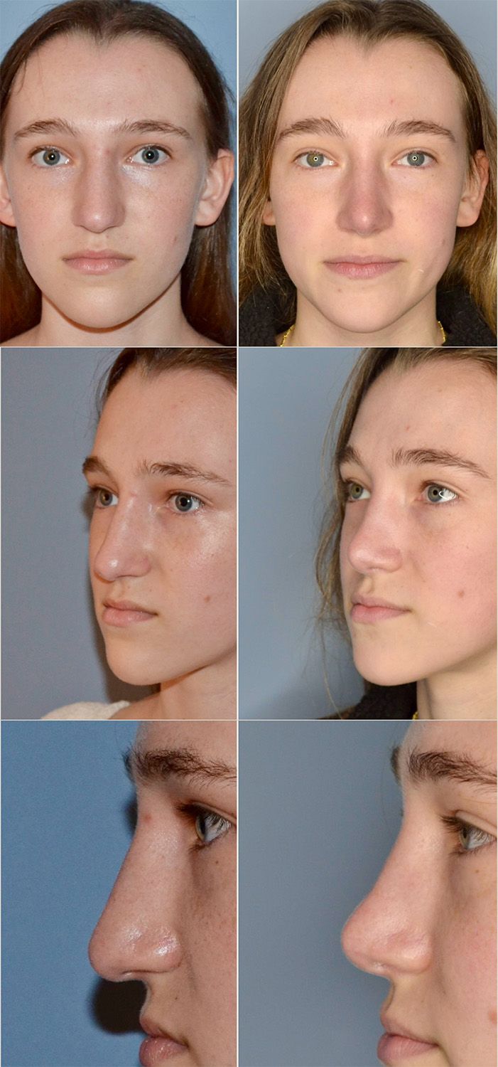 Rhinoplasty Performed by Dr. Baccaro