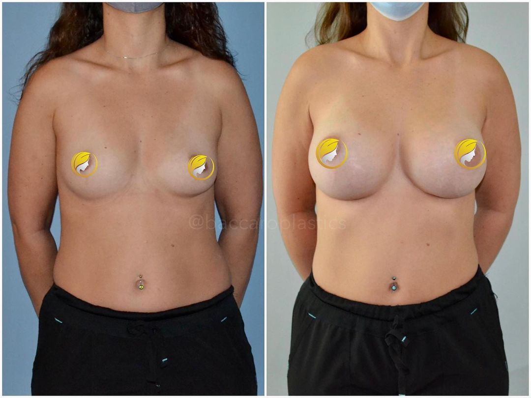 Hybrid Breast Augmentation by Dr. Baccaro
