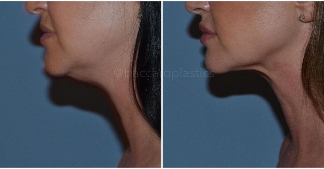 Neck Lipo and Renuvion