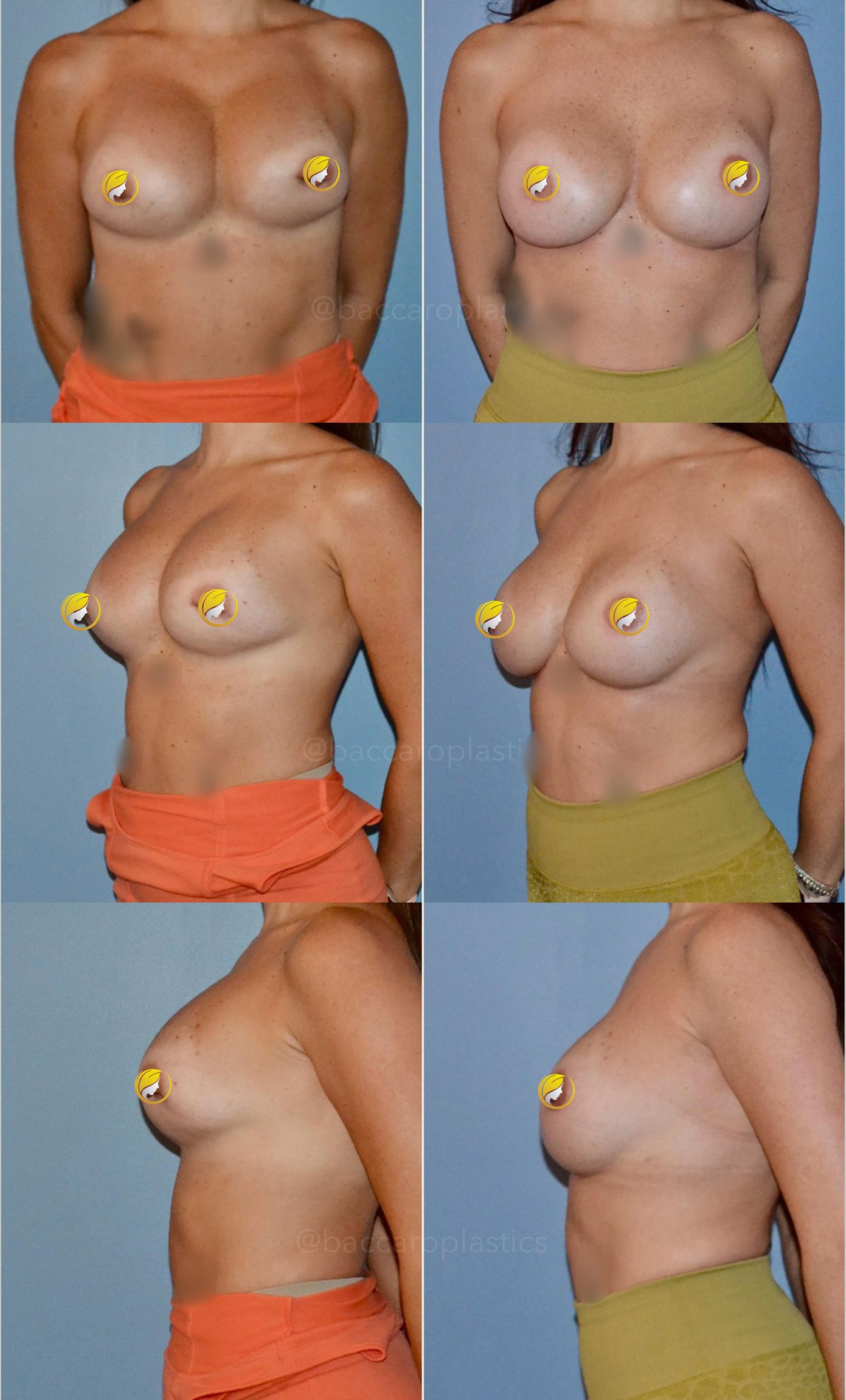 Breast Implant Exchange Performed by Dr. Baccaro