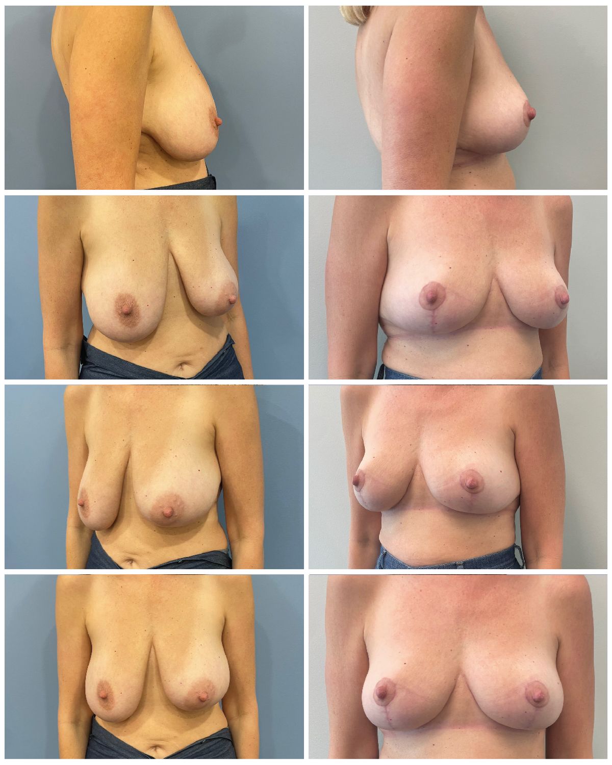 Dr. Walsh – Breast Reduction Patient 3