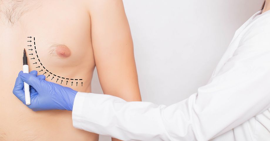 Gynecomastia