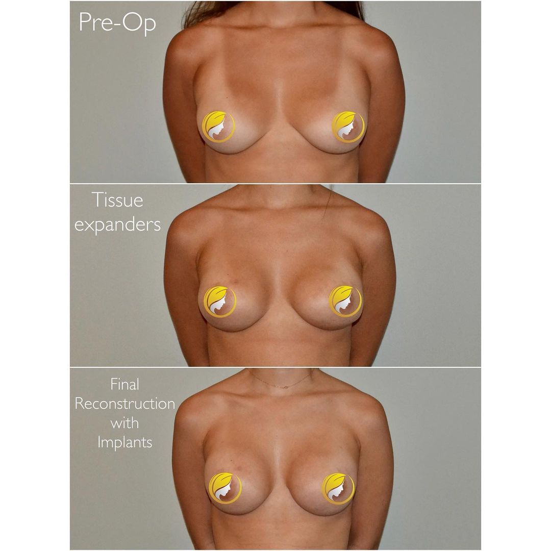 Breast Reconstruction by Dr. Baccaro
