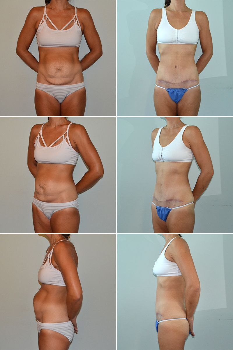 tummy tuck 12