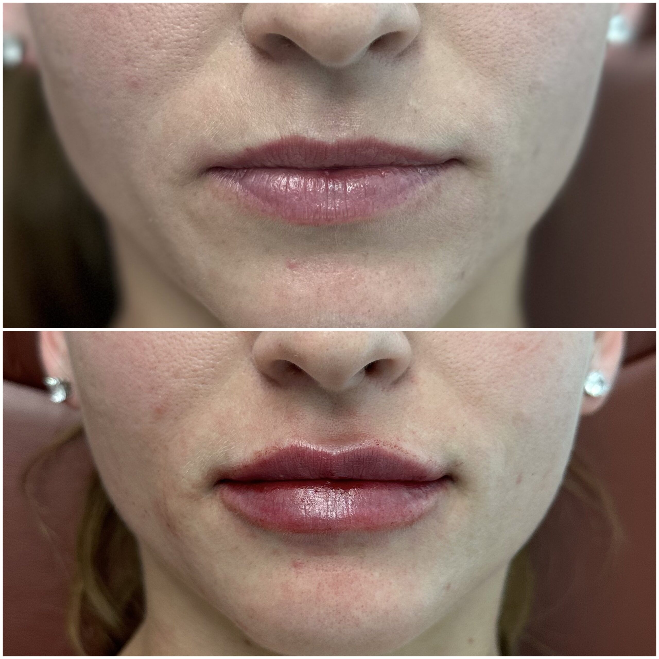 Lip Filler by Dr. Baccaro