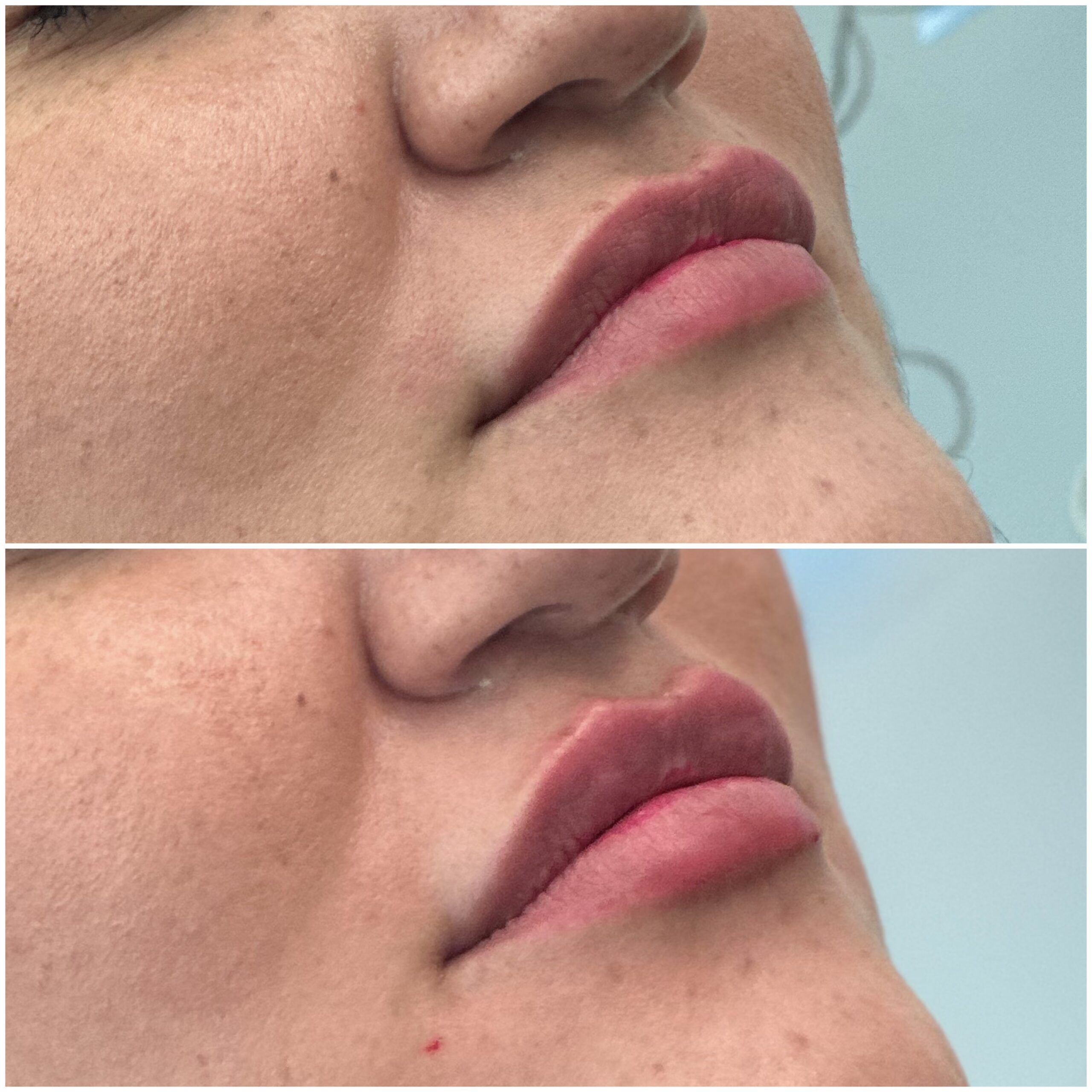 Lip Filler by Dr. Baccaro