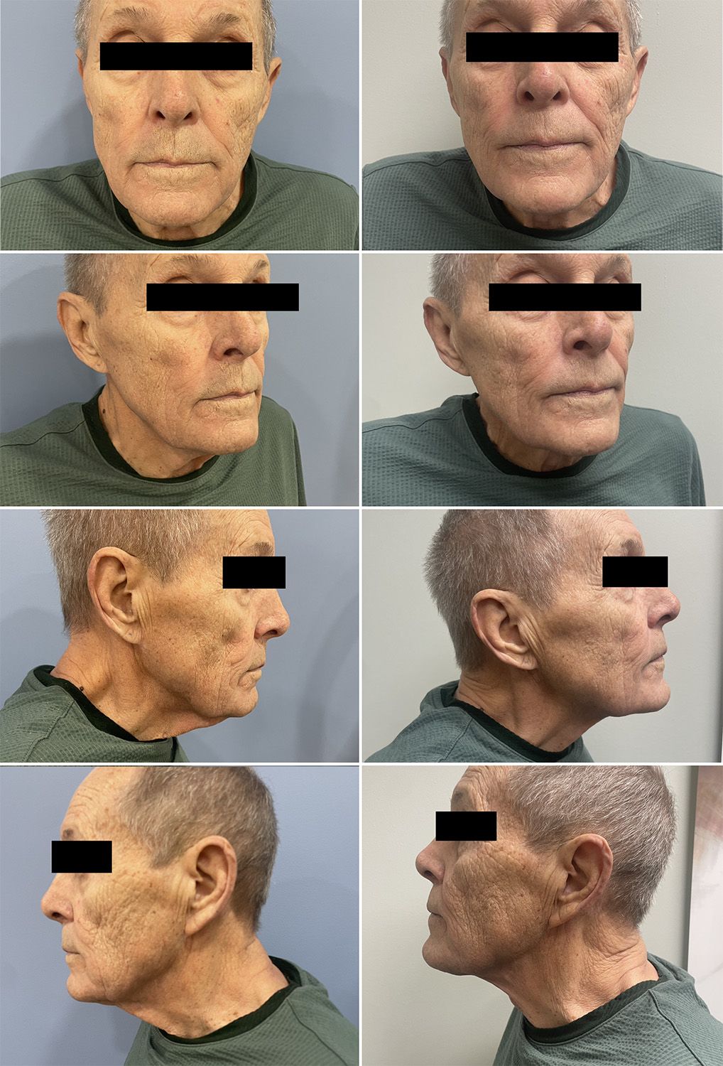 Anterior Cervicoplasty Performed by Dr Walsh