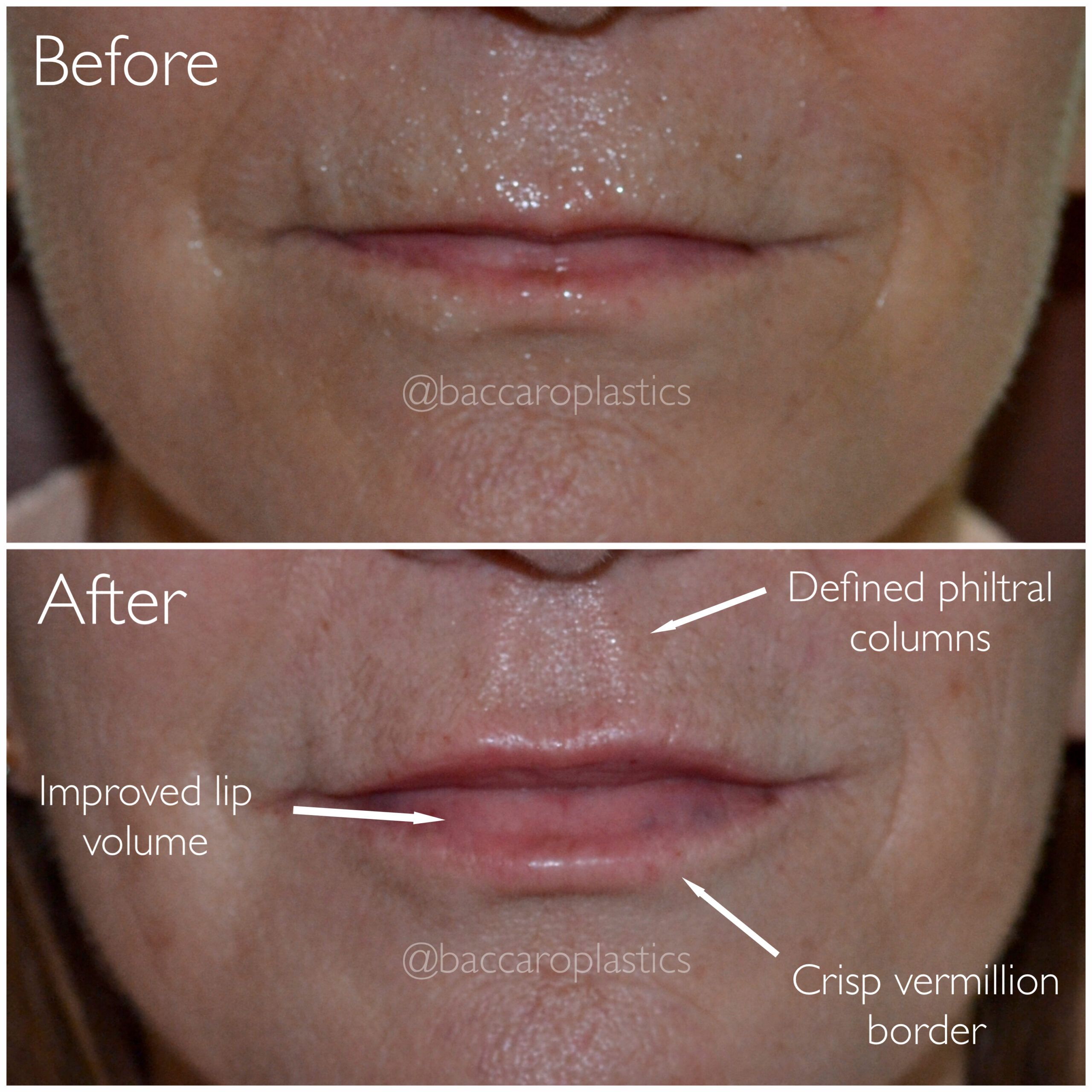 Lip Filler by Dr. Baccaro