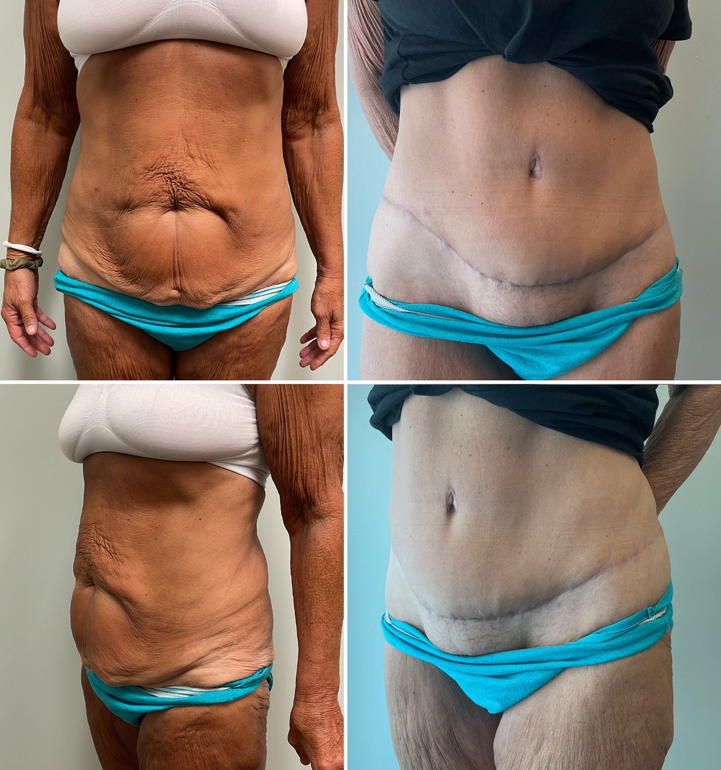 Abdominoplasty by Dr. Andrew Bonett