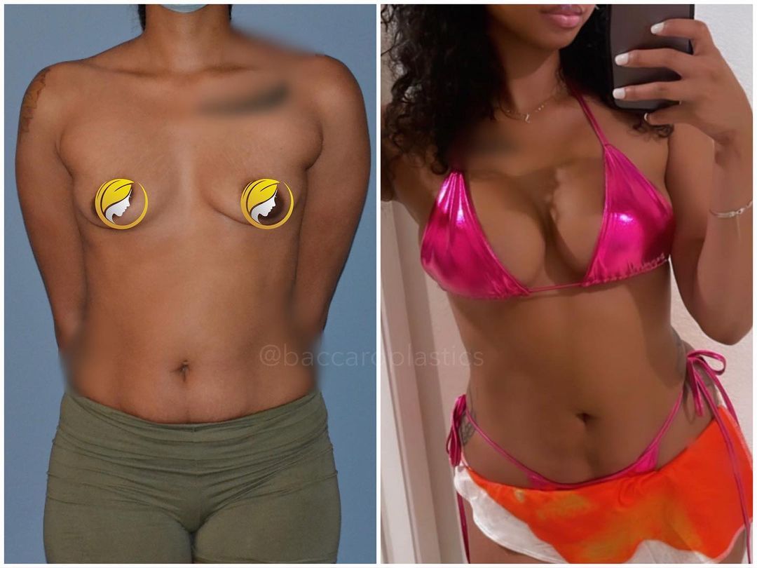 Hybrid Breast Augmentation by Dr. Baccaro