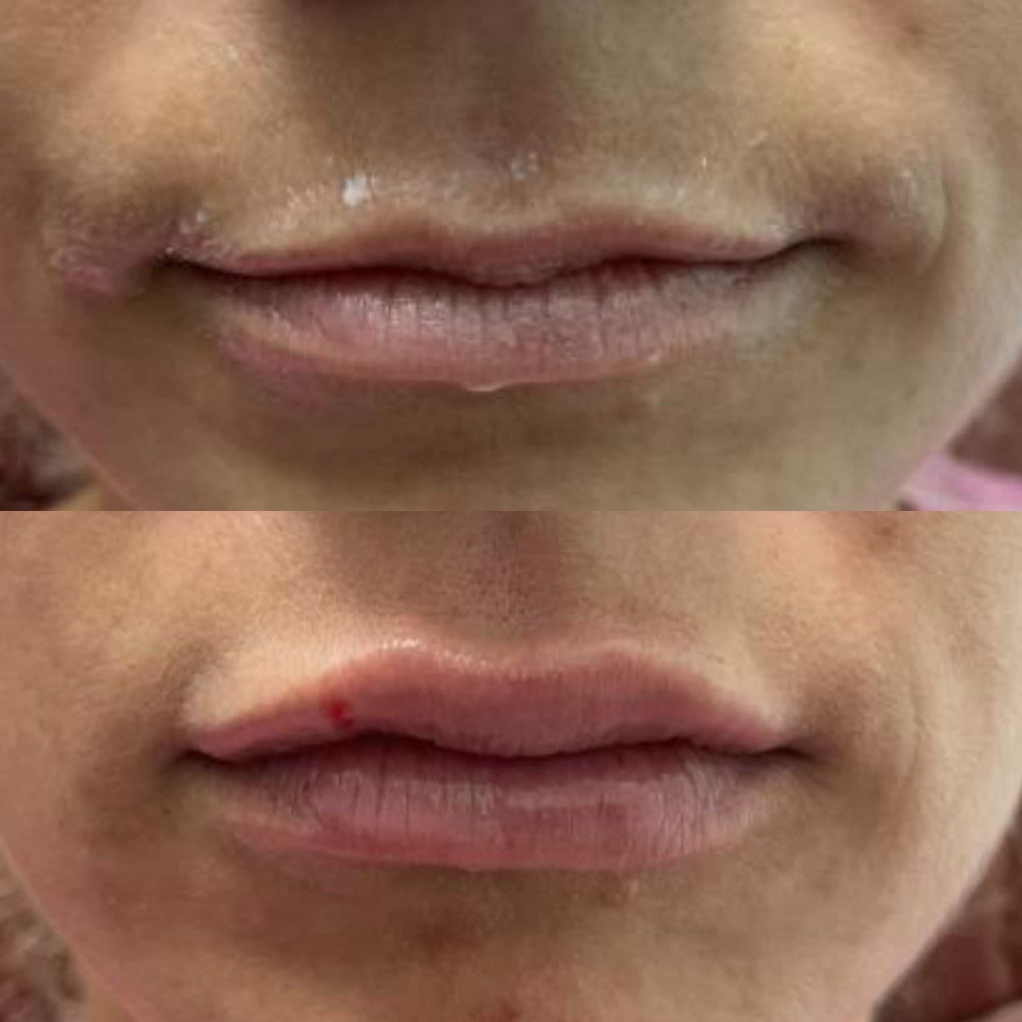 Lip Filler Performed by Dr. Bonett
