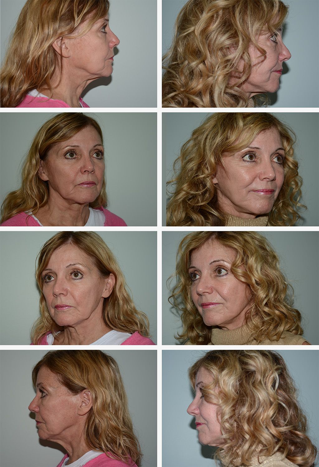 Mini Facelift Performed by Dr. Gardner