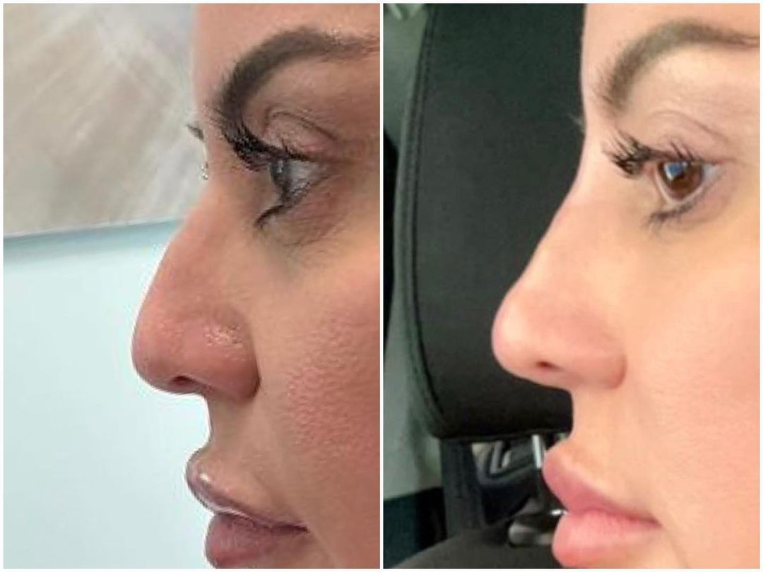 Rhinoplasty by Dr. Baccaro