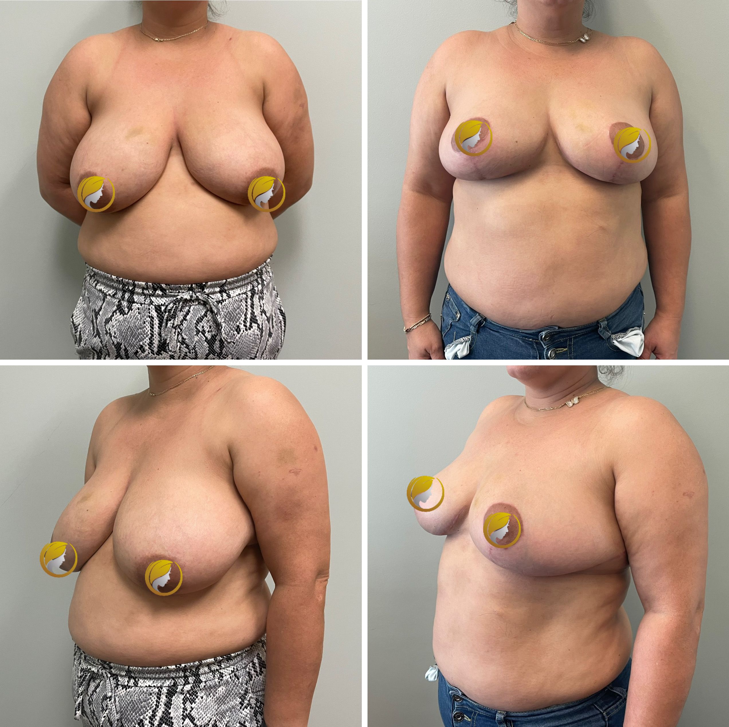 Surgery Performed by Dr. Andrew Bonett