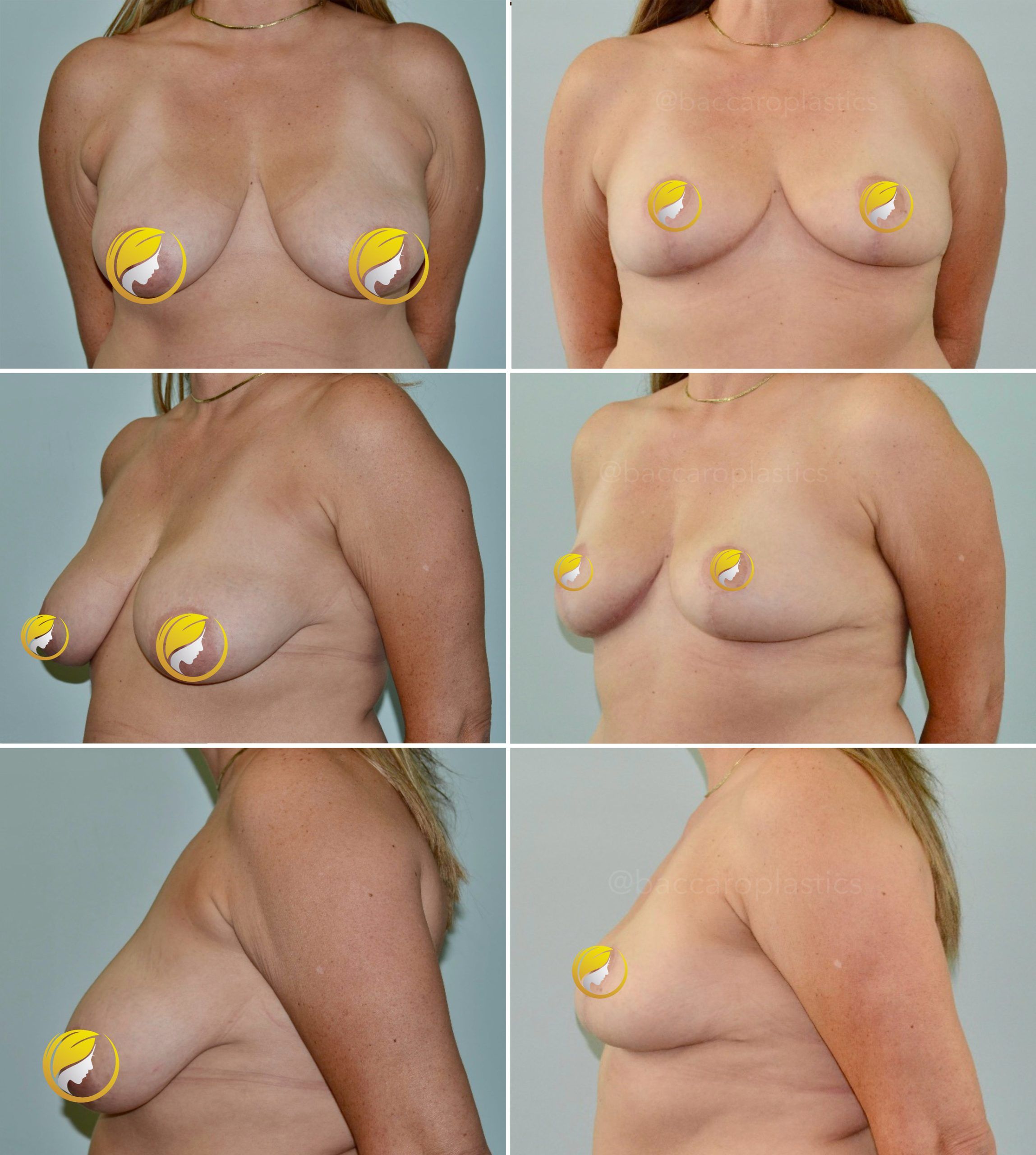 Breast Reduction Performed by Dr. Baccaro
