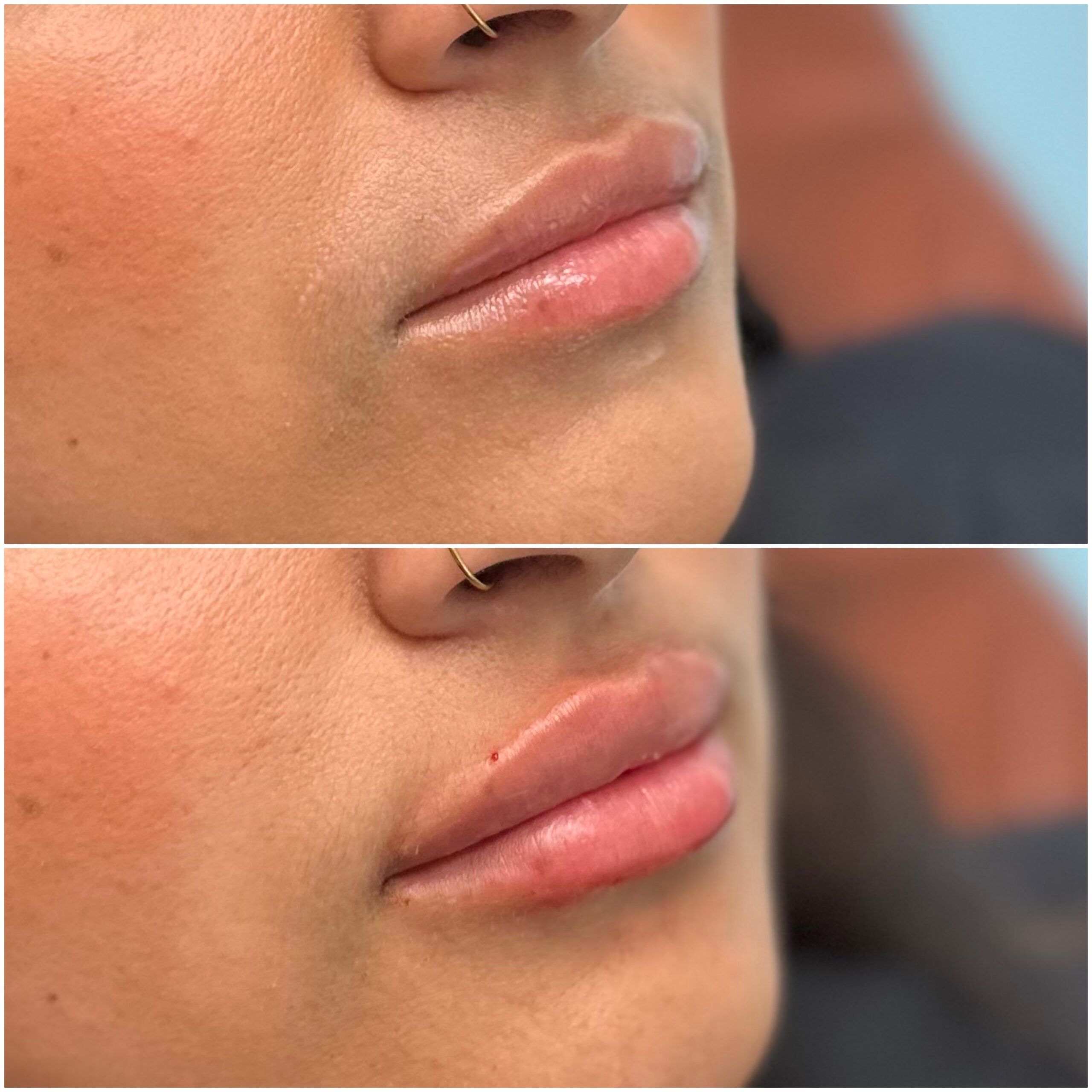 Lip Filler by Dr. Baccaro