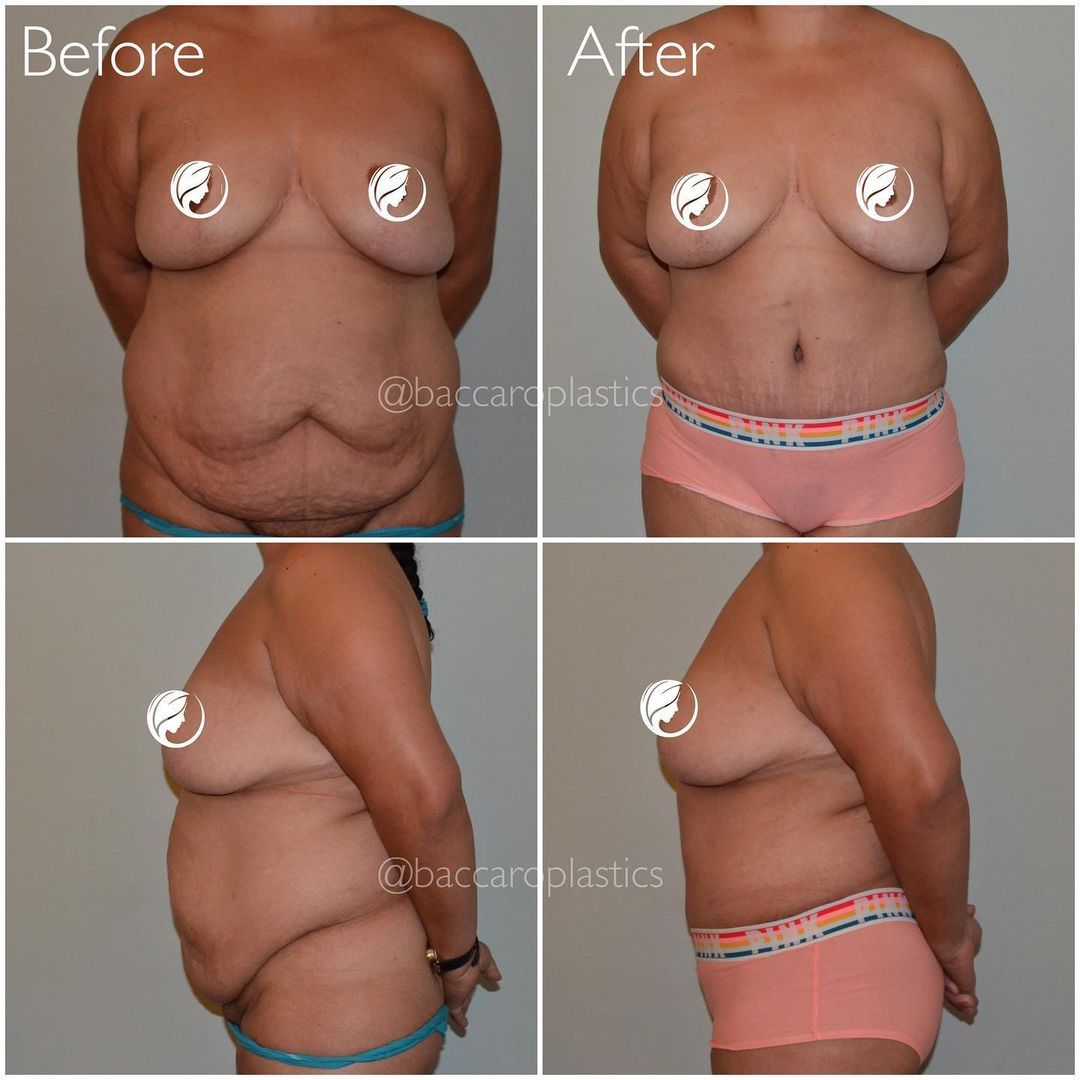 Tummy Tuck by Dr. Baccaro