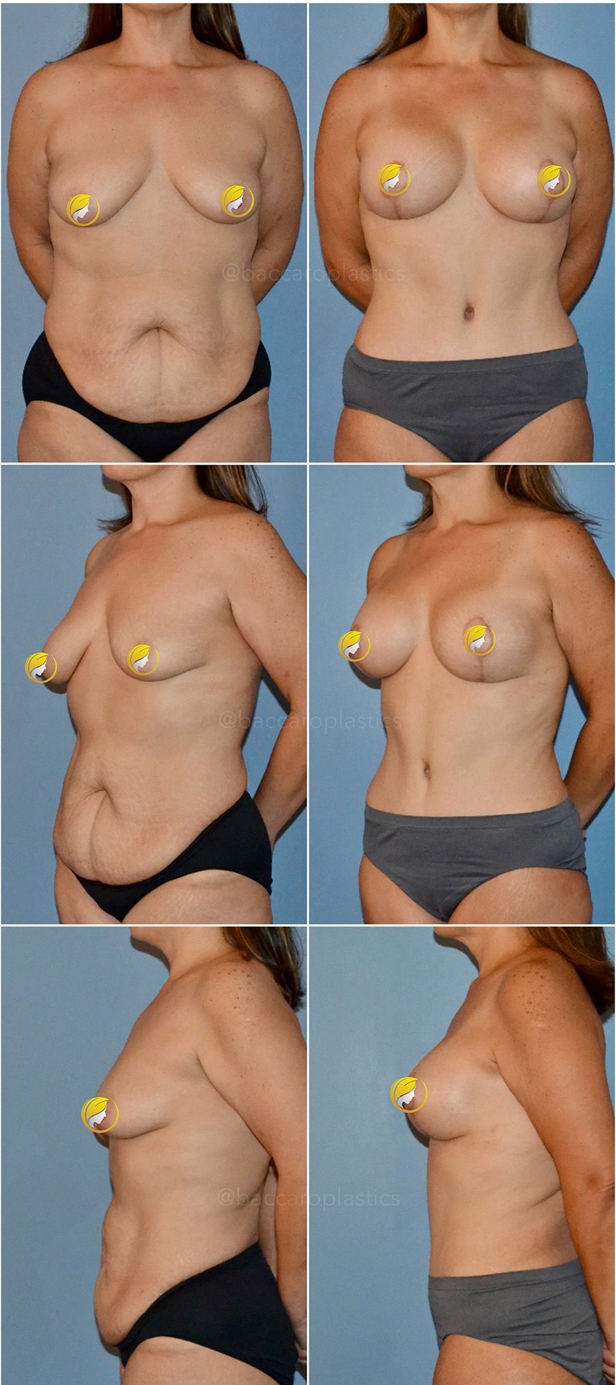 Mommy Makeover Performed by Dr. Baccaro