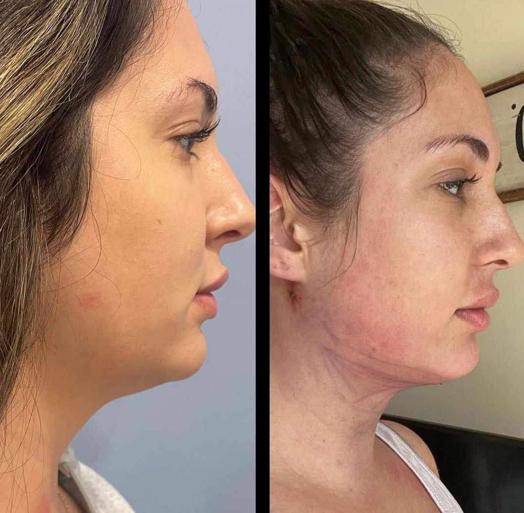 Renuvion Neck by Dr. Andrew Bonett