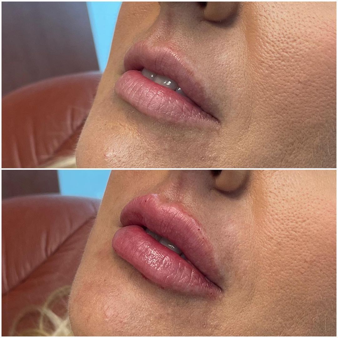 Lip Augmentation by Dr. Baccaro