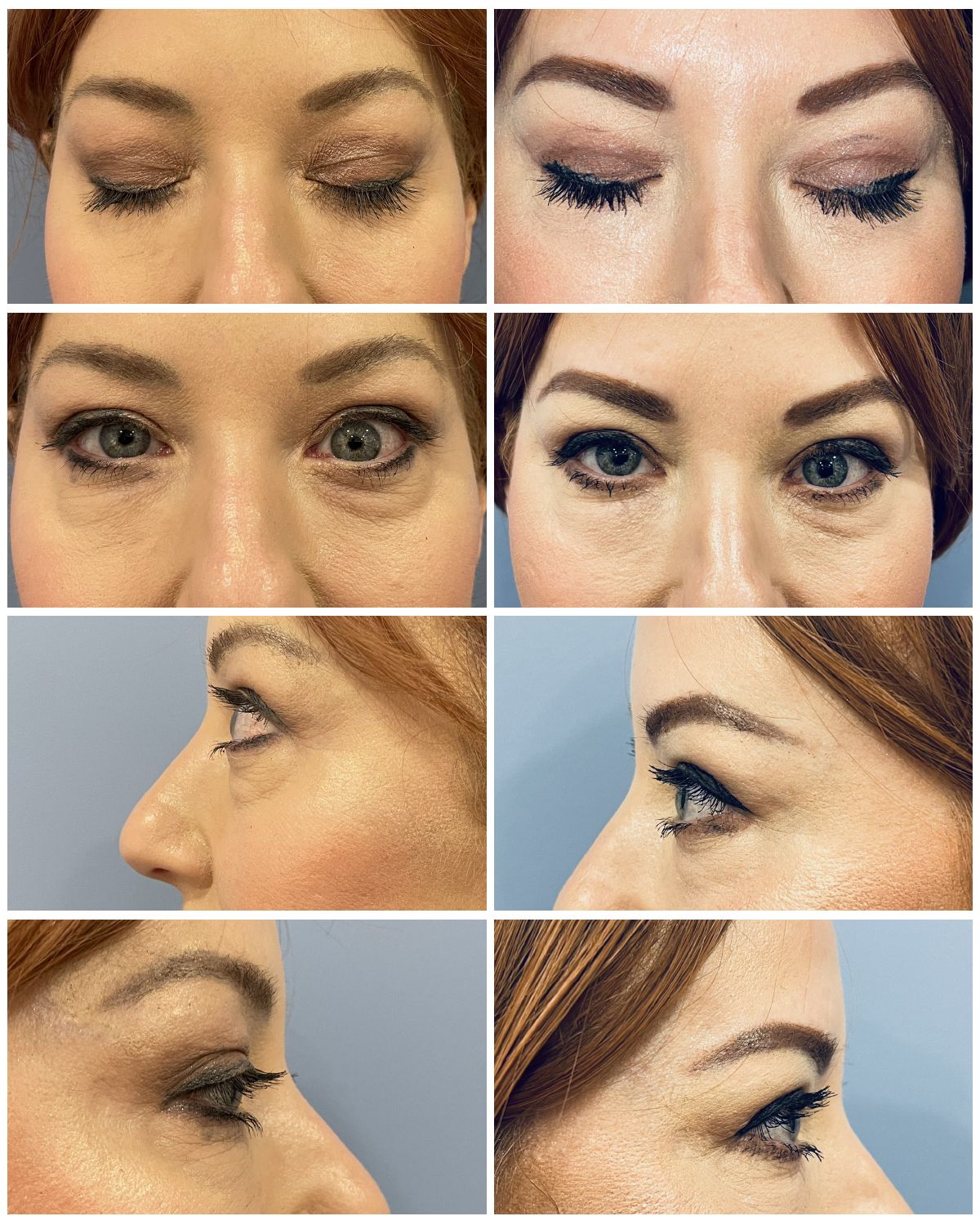Dr.-Andrew-Bonett Upper Blepharoplasty