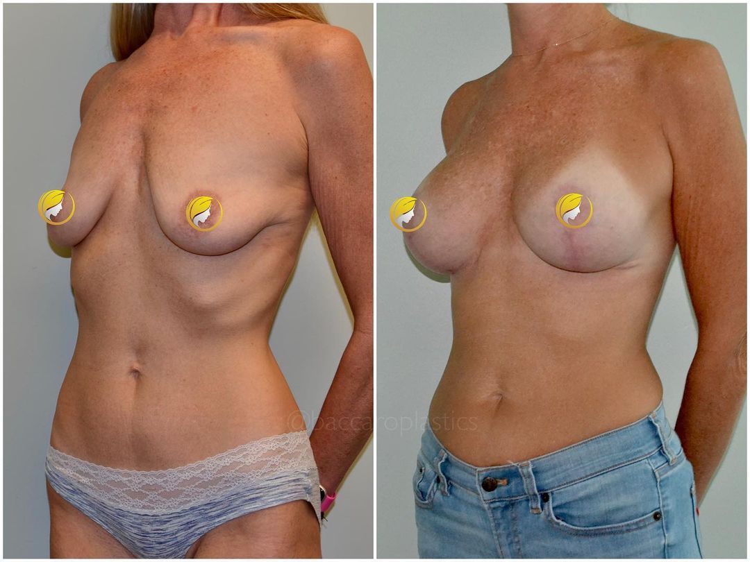 Implant Placement and Lift by Dr. Baccaro