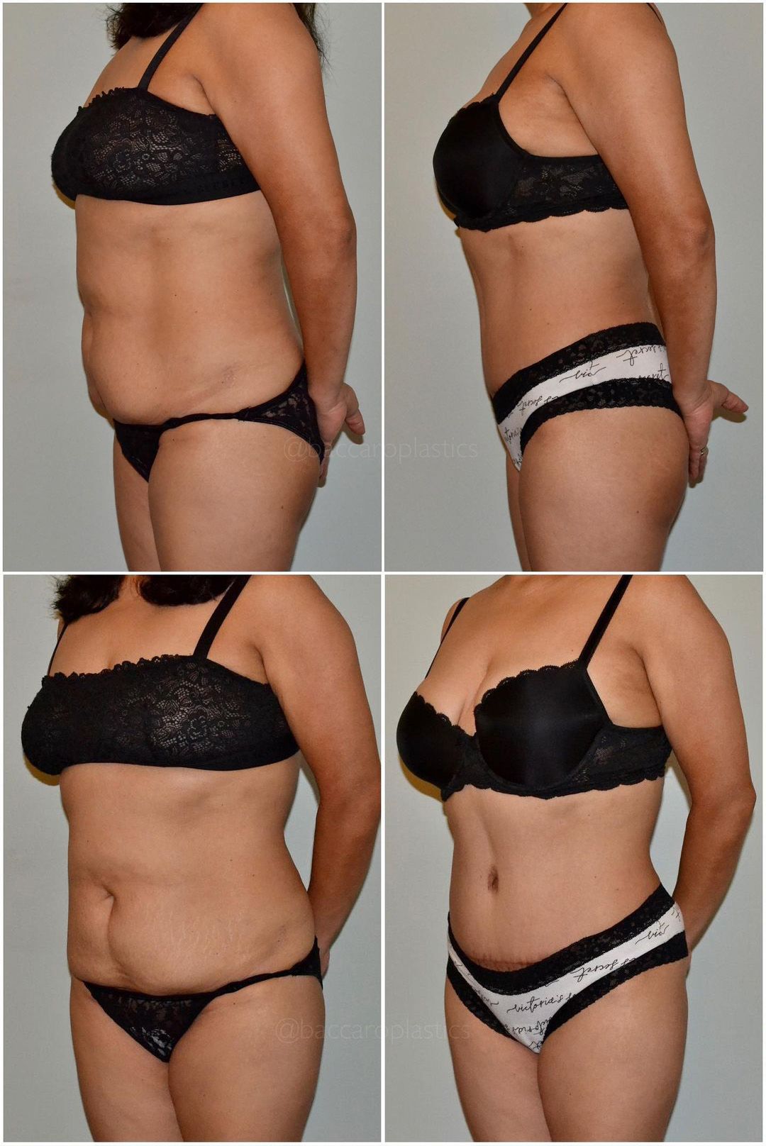 Liposuction by Dr. Leo Baccaro