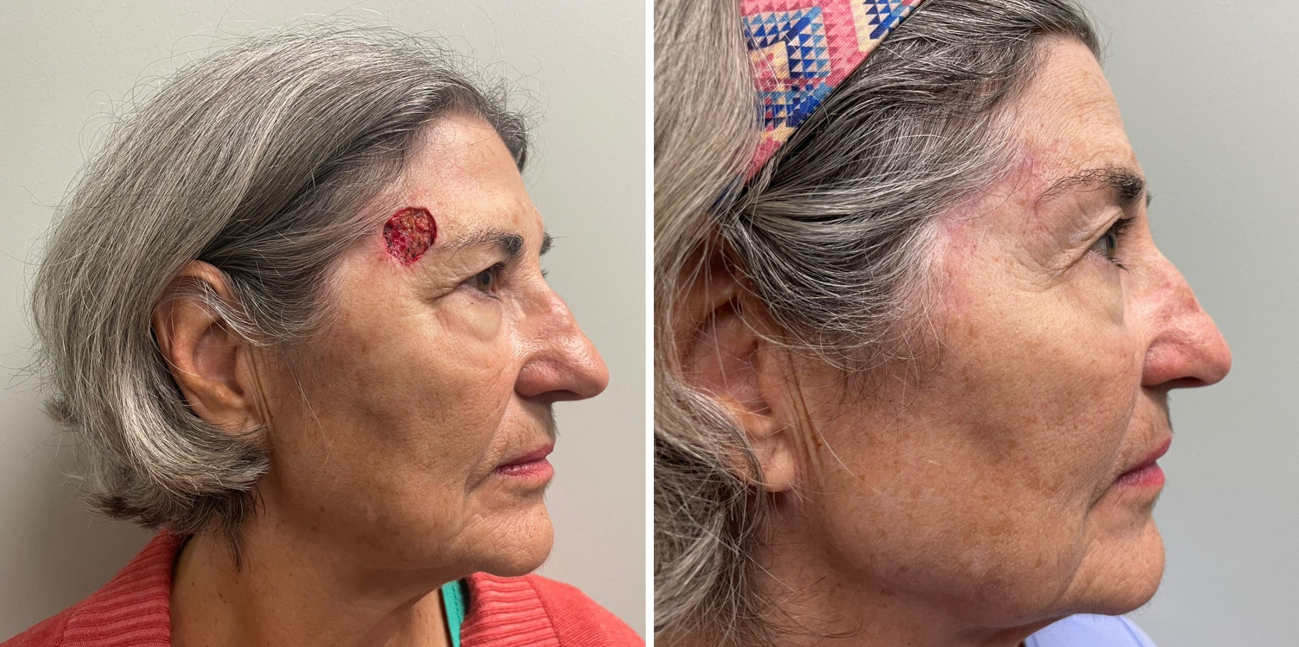 Mohs Reconstruction Surgery by Dr. Bonett 