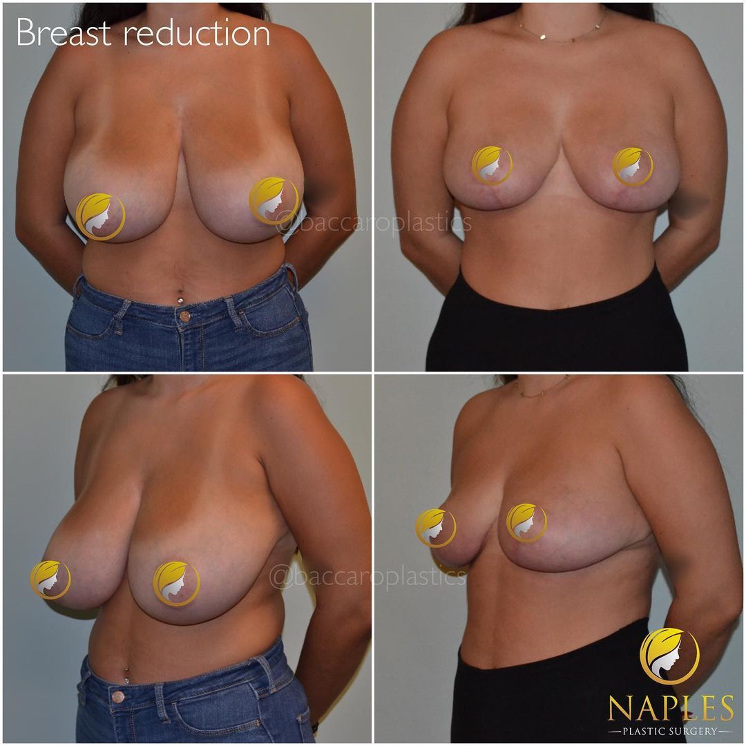 Breast Reduction and Lift by Dr. Baccaro 