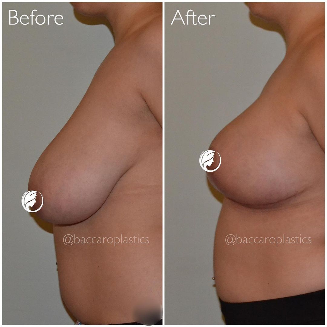 Breast Reduction and Lift by Dr. Baccaro