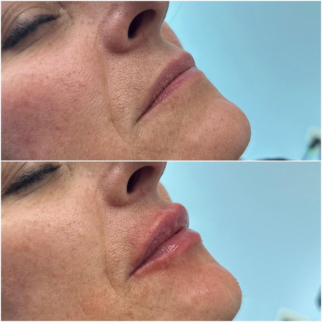 Lip Augmentation by Dr. Baccaro