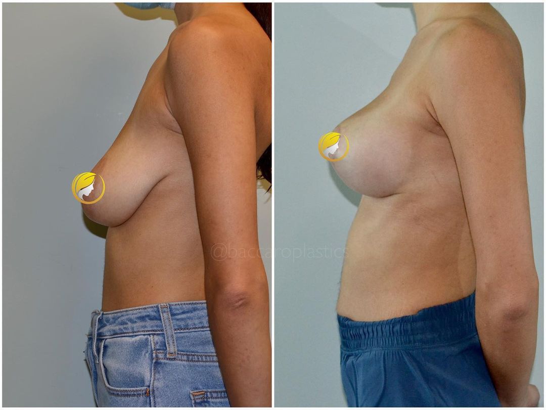 Breast Lift by Dr. Baccaro