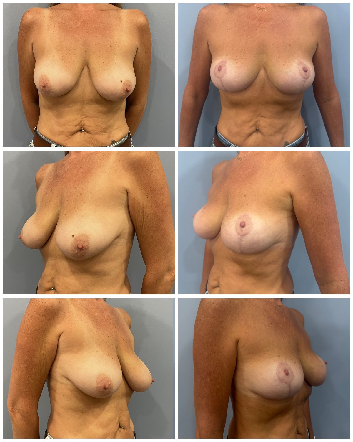 Breast Lift and Breast Reduction Performed by Dr. Bonett