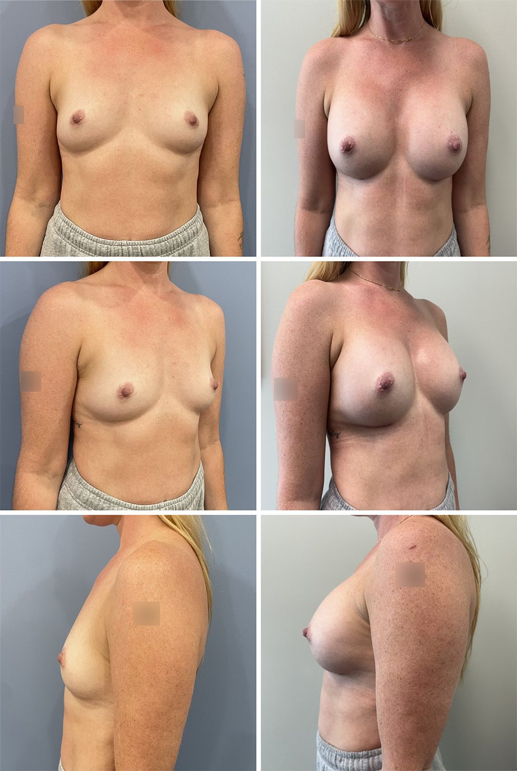 Breast Augmentation Performed by Dr. Walsh