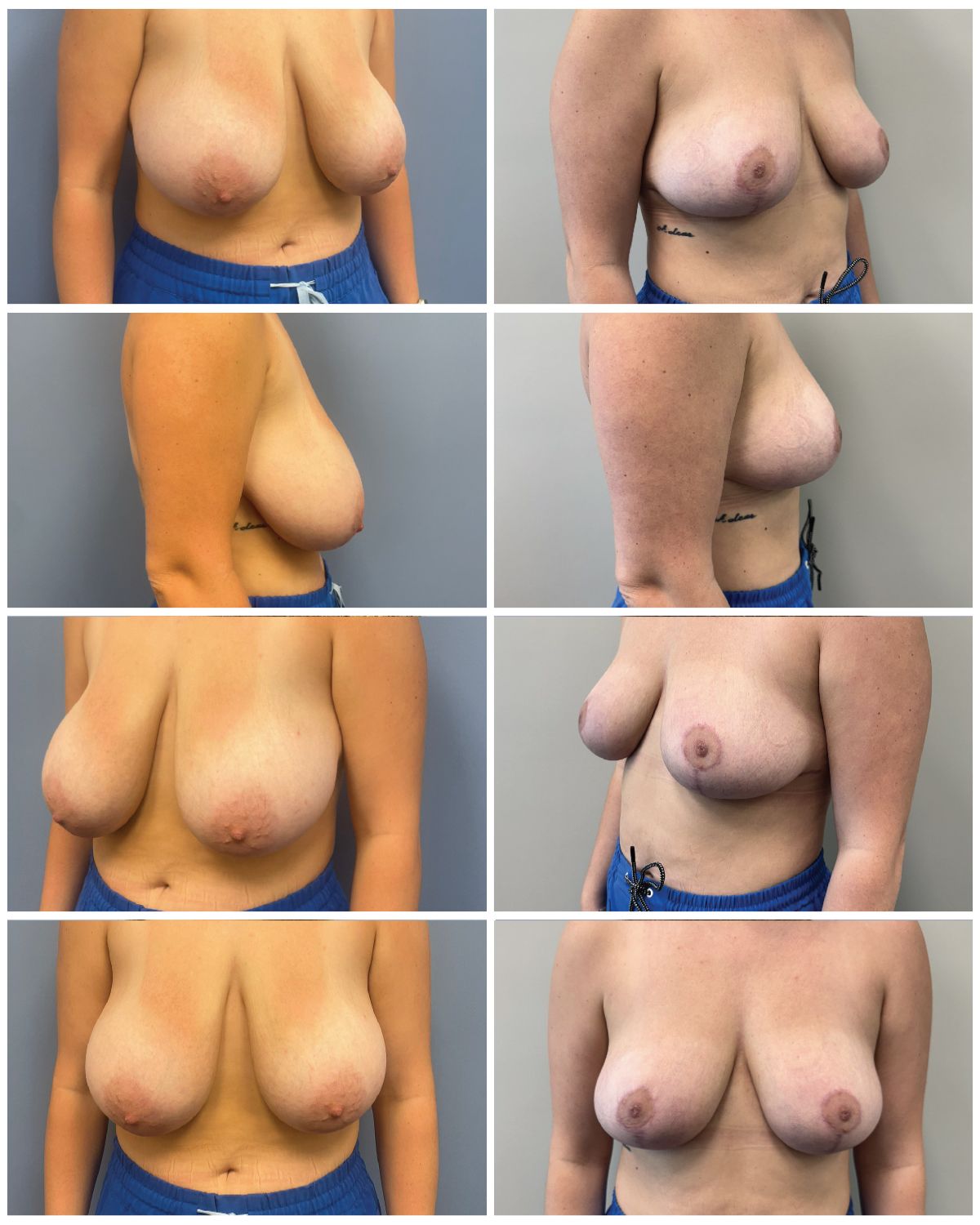 Dr. Walsh – Breast Reduction Patient 2