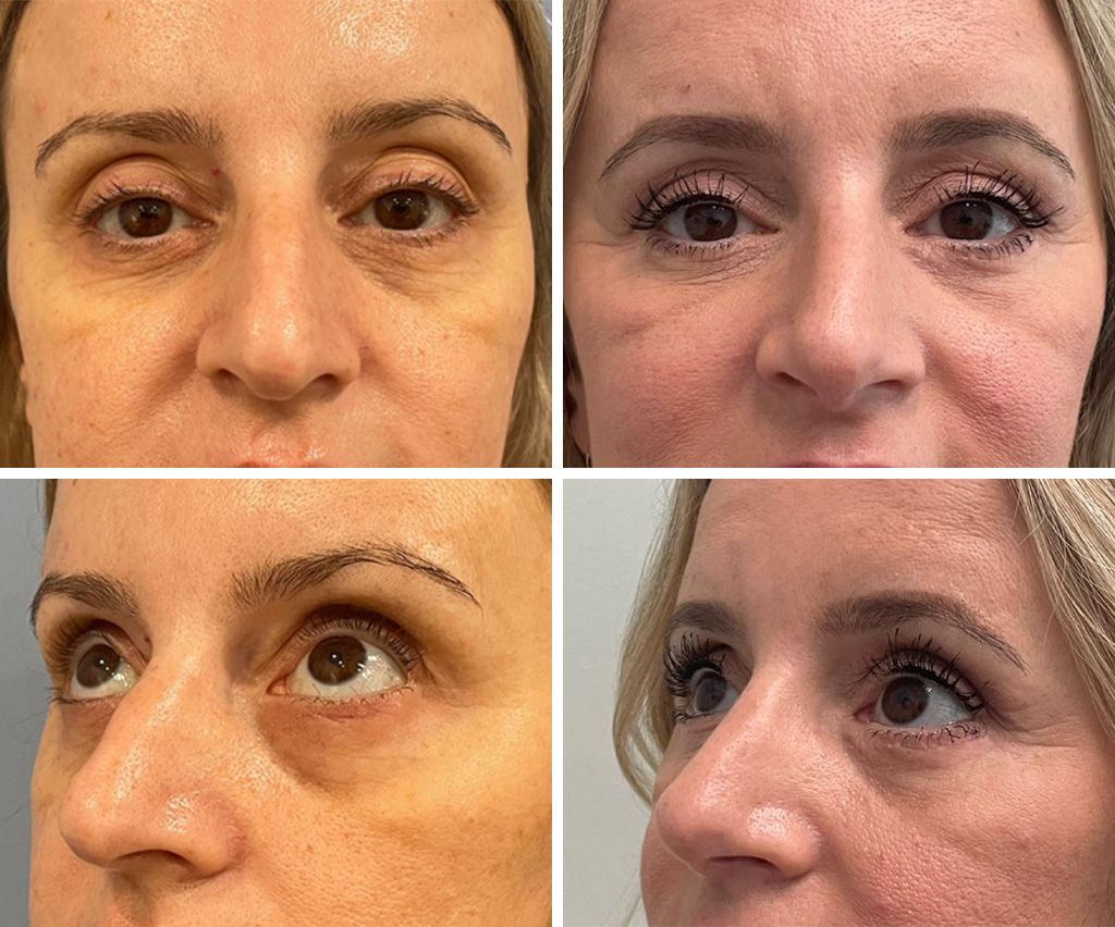 Blepharoplasty performed by Dr. Bonett