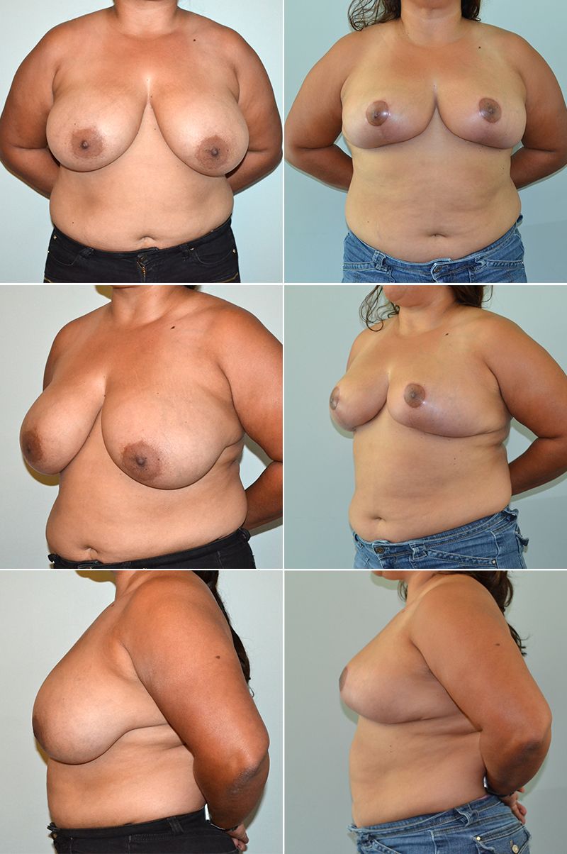 baccaro breast reduction 3