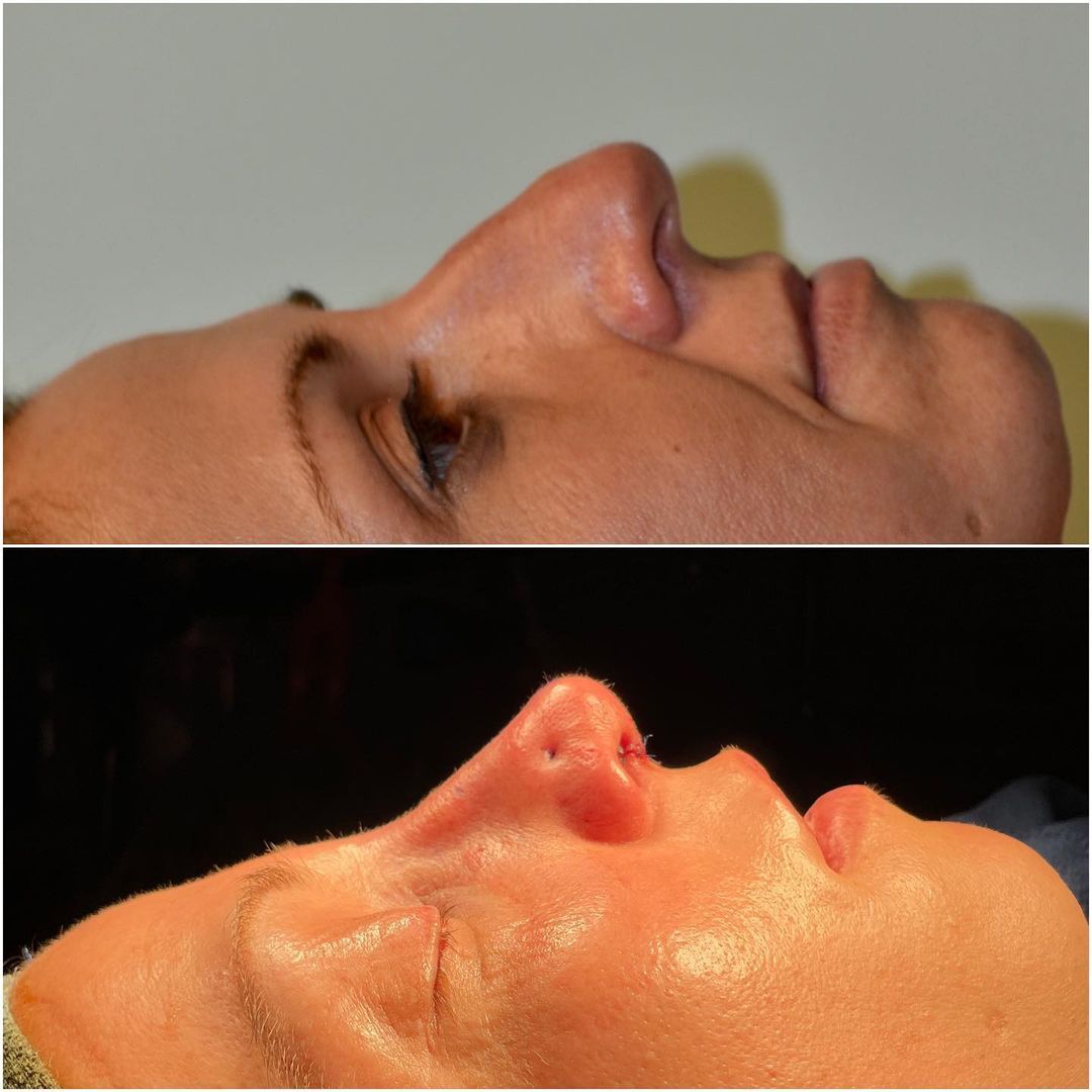 Rhinoplasty by Dr. Baccaro