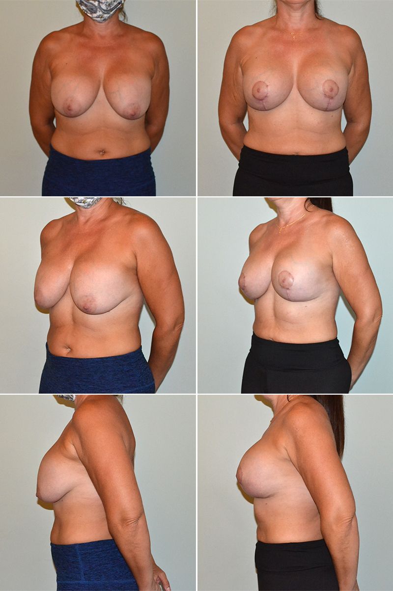 Dr. Paul Gardner breast implant revision before and after image
