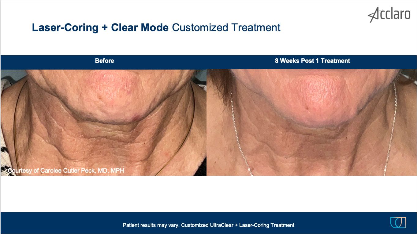 UltraClear Laser Performed by Carolee Cutler Peck