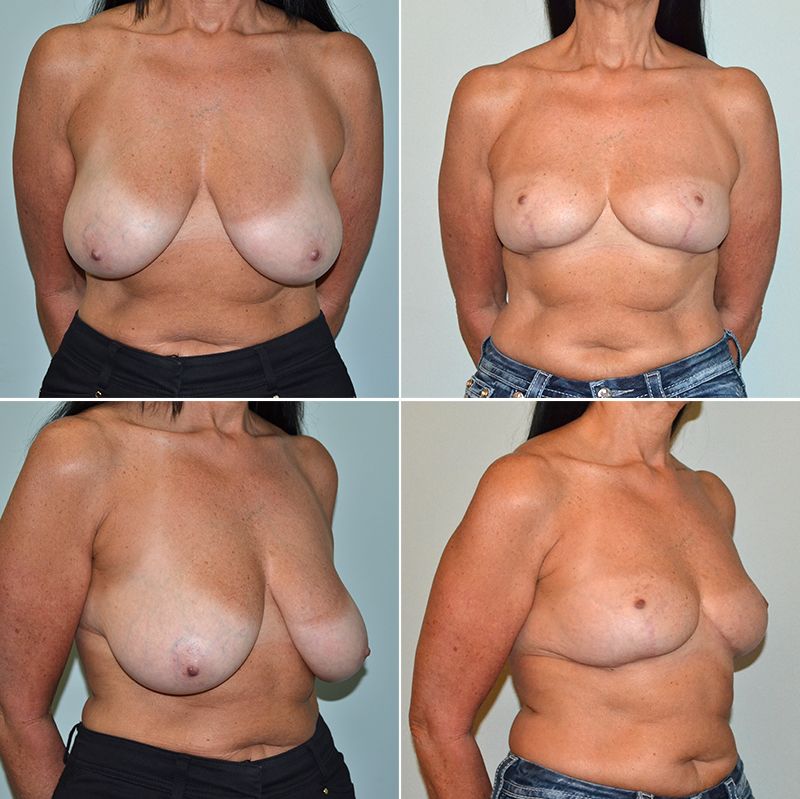 baccaro breast reduction 3