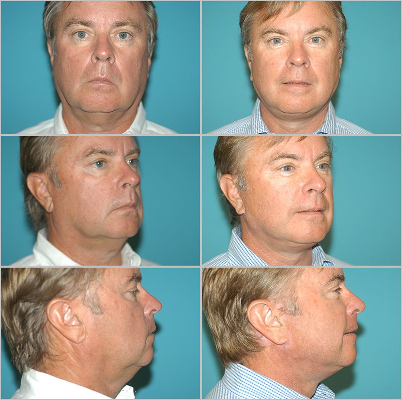 Neck Lift 02
