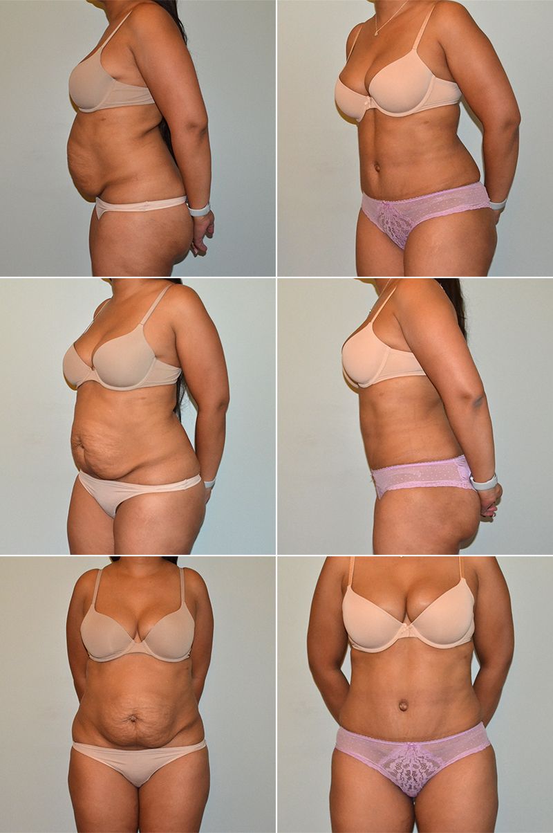 tummy tuck 12