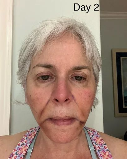 Neck Lift & Facial Fat Transfer Day 2