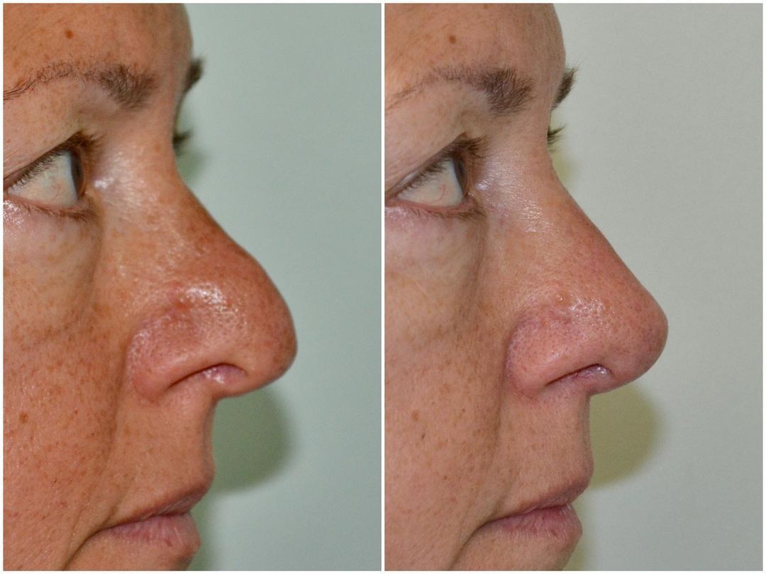 Rhinoplasty by Dr. Baccaro