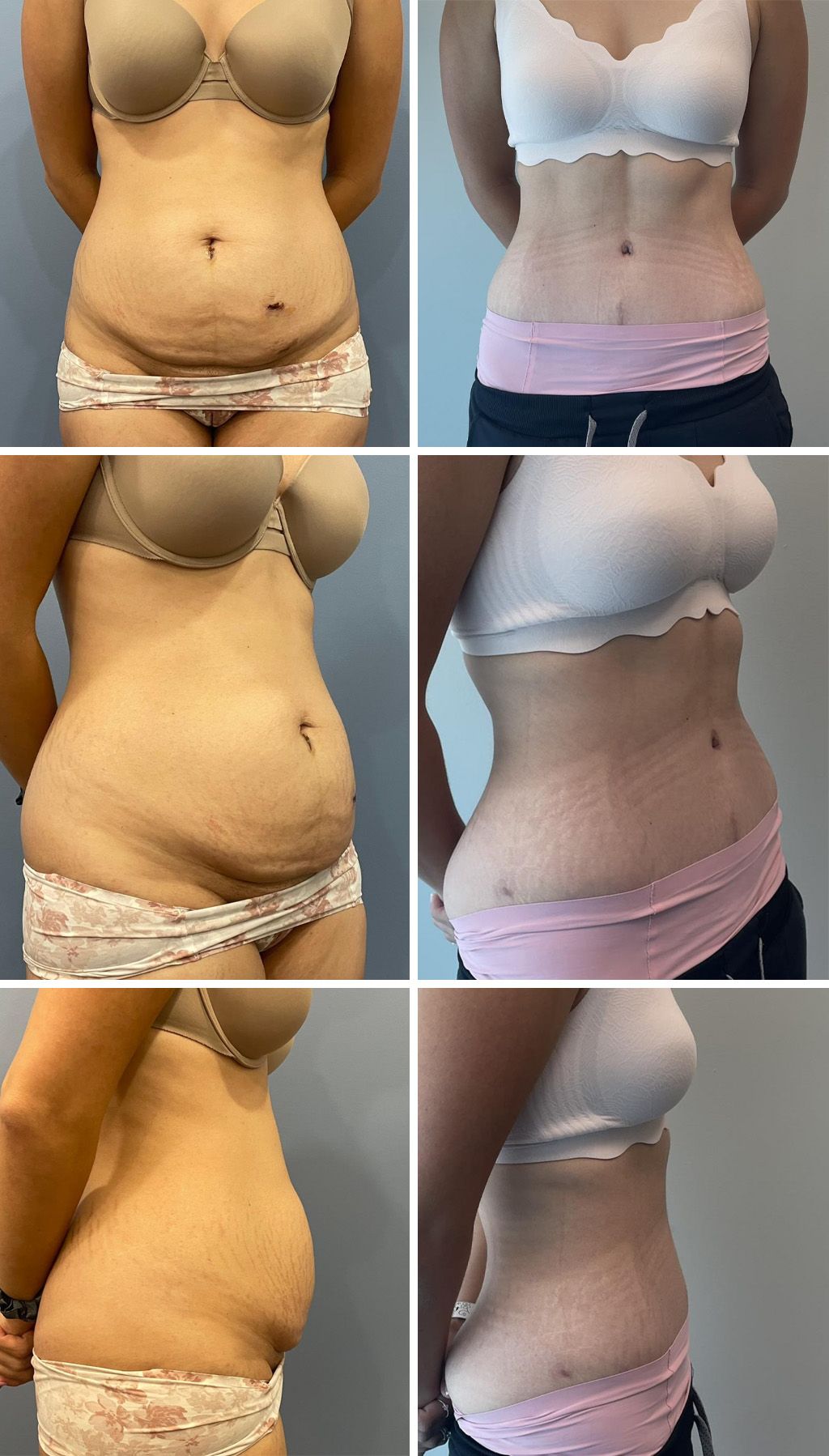 Tummy Tuck Performed by Dr. Bonett